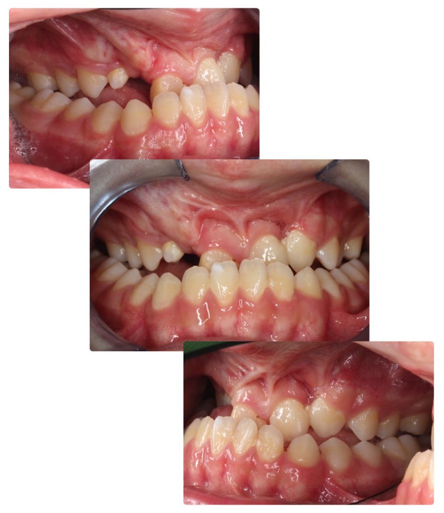 plan de traitement orthodontico-chirurgical