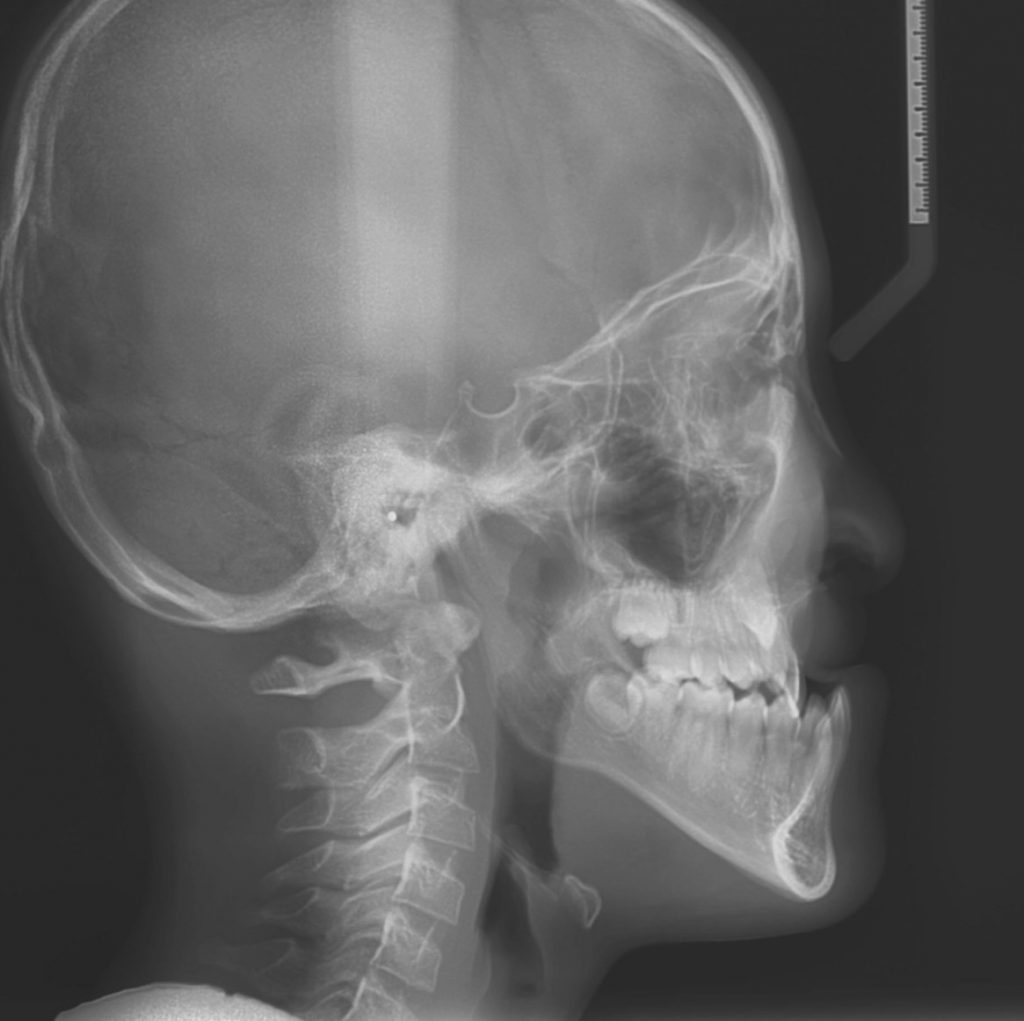 Téléradiographie de profil